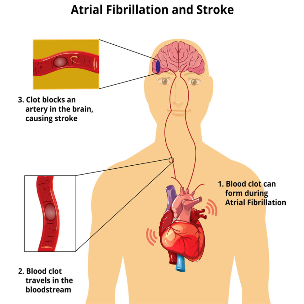 Faq Neuro Patients Rhythm30 4644